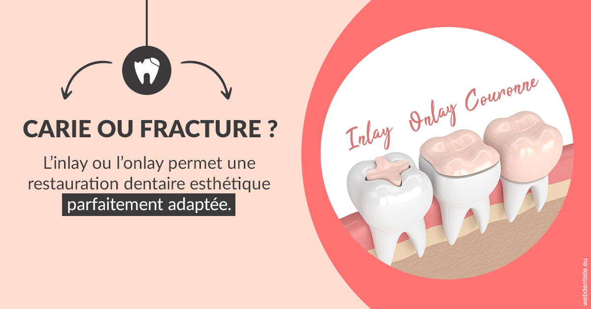 https://dr-grosman-gilles.chirurgiens-dentistes.fr/T2 2023 - Carie ou fracture 2