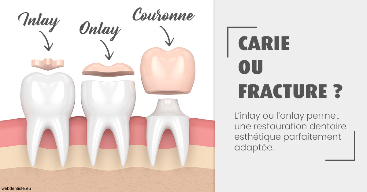 https://dr-grosman-gilles.chirurgiens-dentistes.fr/T2 2023 - Carie ou fracture 1