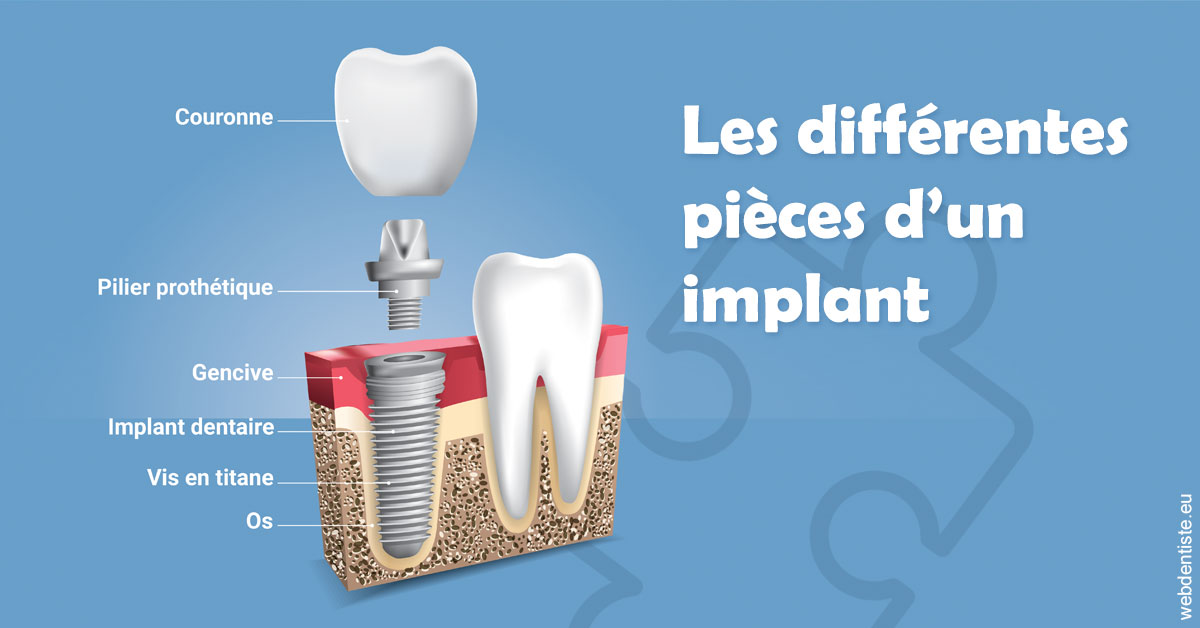 https://dr-grosman-gilles.chirurgiens-dentistes.fr/Les différentes pièces d’un implant 1